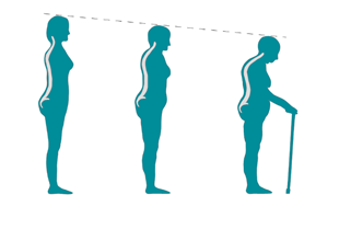 Typische Veränderungen in der Körperhaltung im Laufe der Zeit durch Osteoporose.