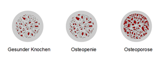 Das Bild zeigt die Veränderung in der Knochenstruktur vom gesunden Knochen zum osteoporotischen Knochen mit geringer Knochendichte.